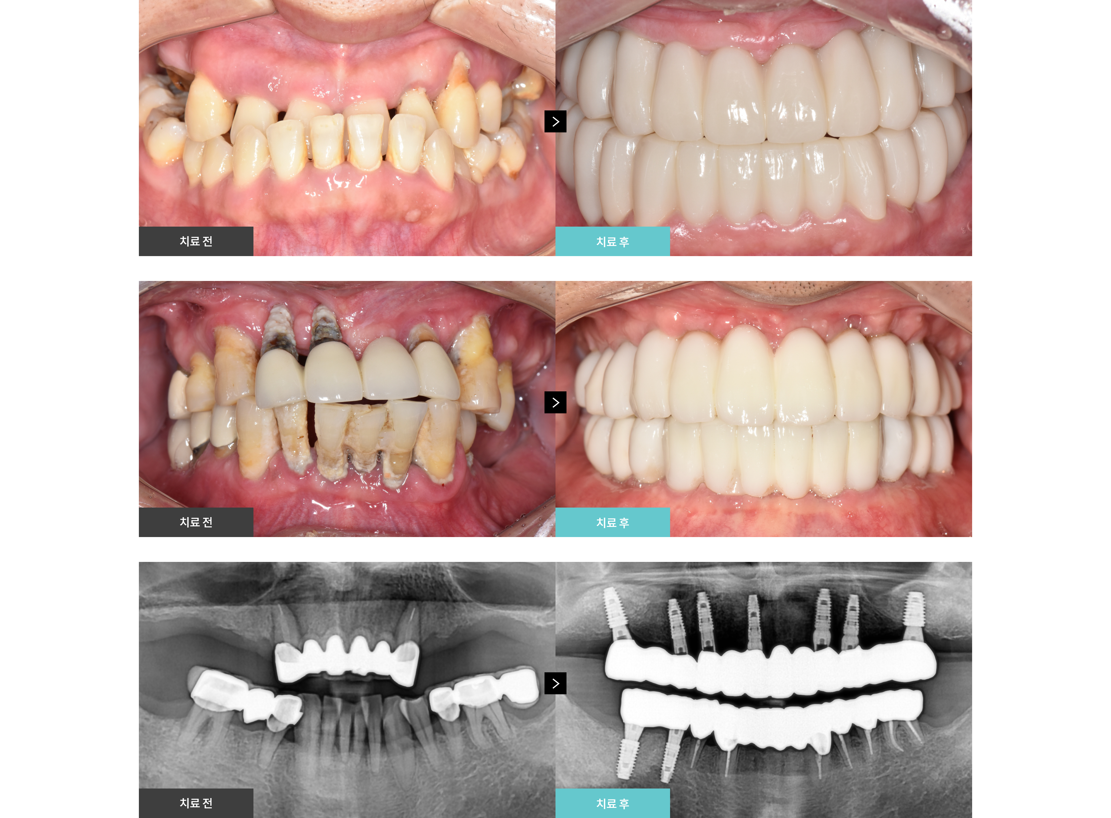 임플란트 Before & After