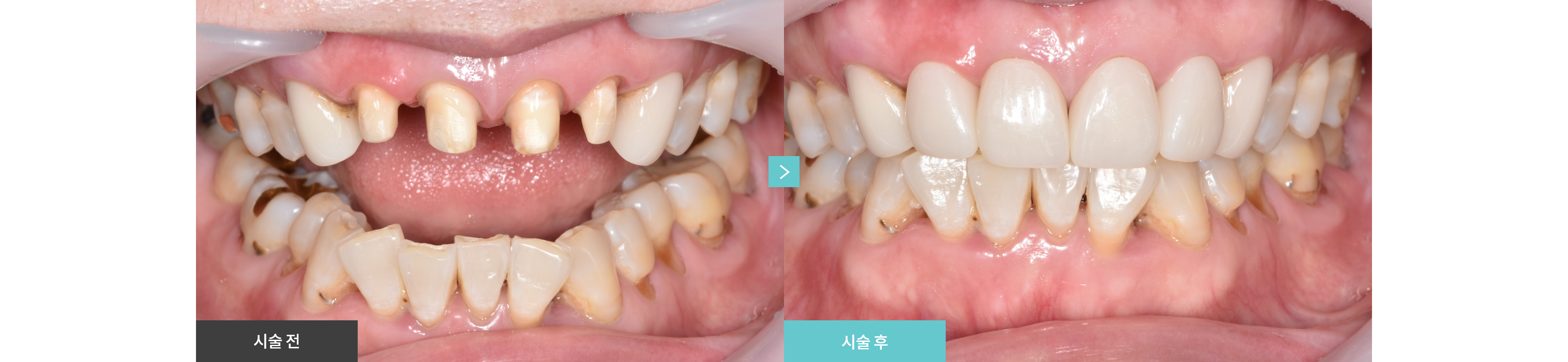 심미보철 Before & After