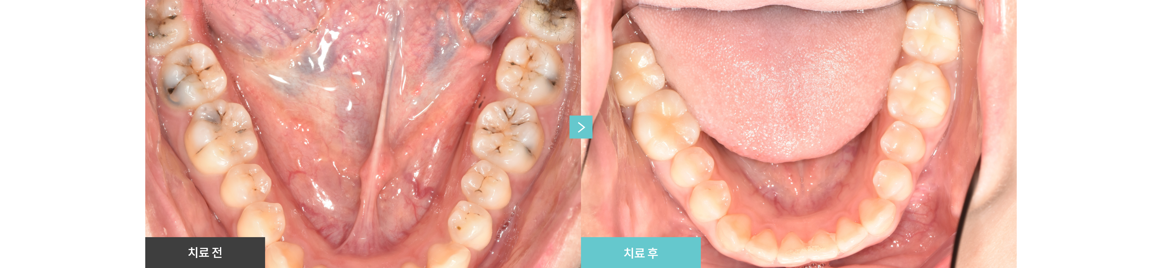 충치치료 Before & After