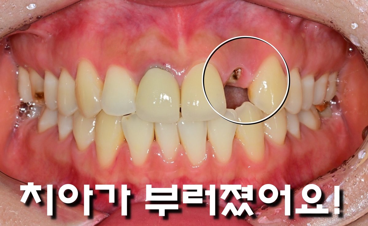 2025.05.20 초진. 빠져버린 측절치 보철