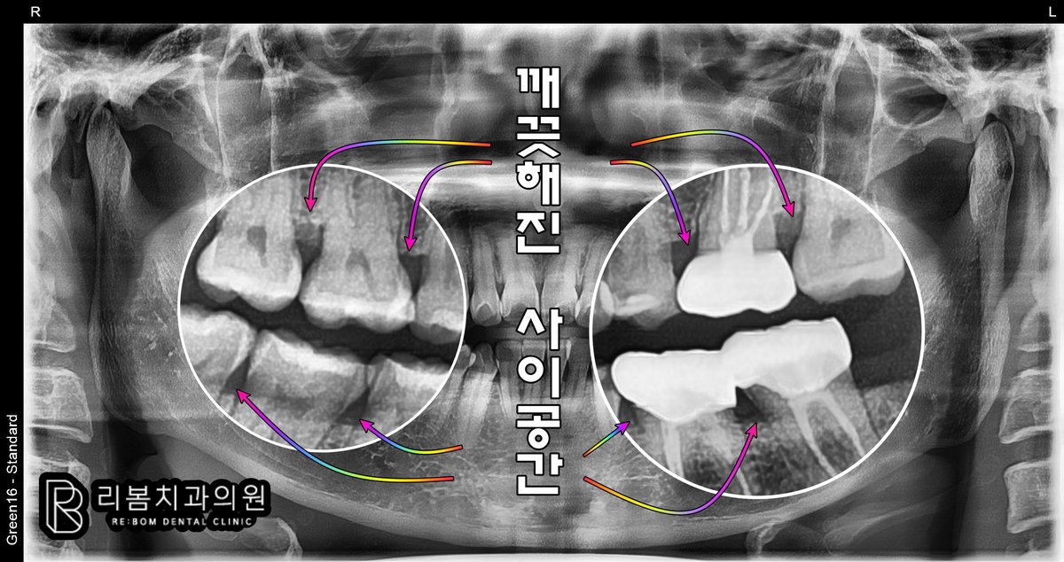잇몸치료 후 파노라마