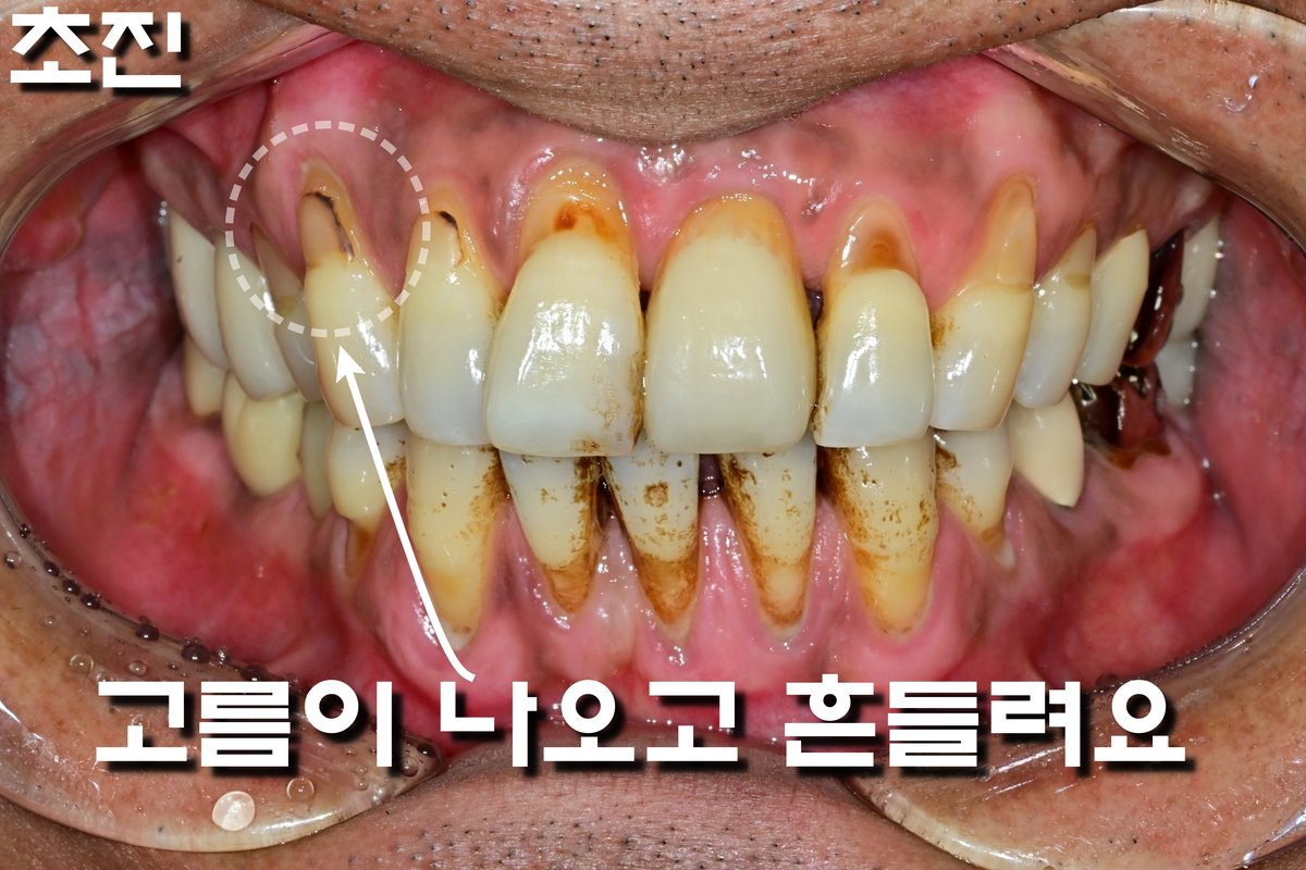 초진사진 250423