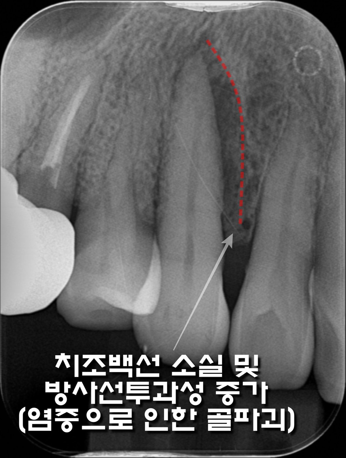 염증으로 인한 골파괴 방사선 사진