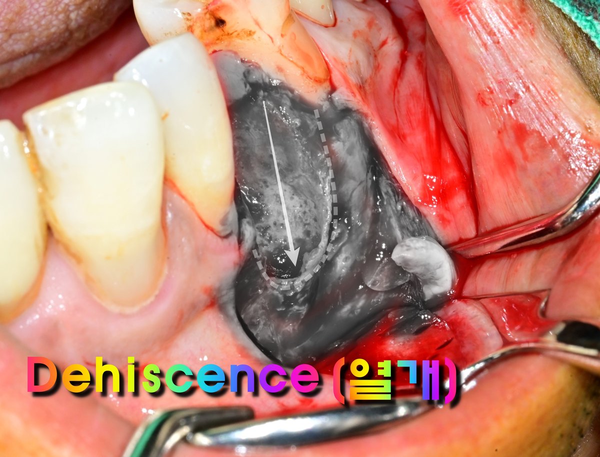 250707_열개 로 인하 골이 파괴된 사진