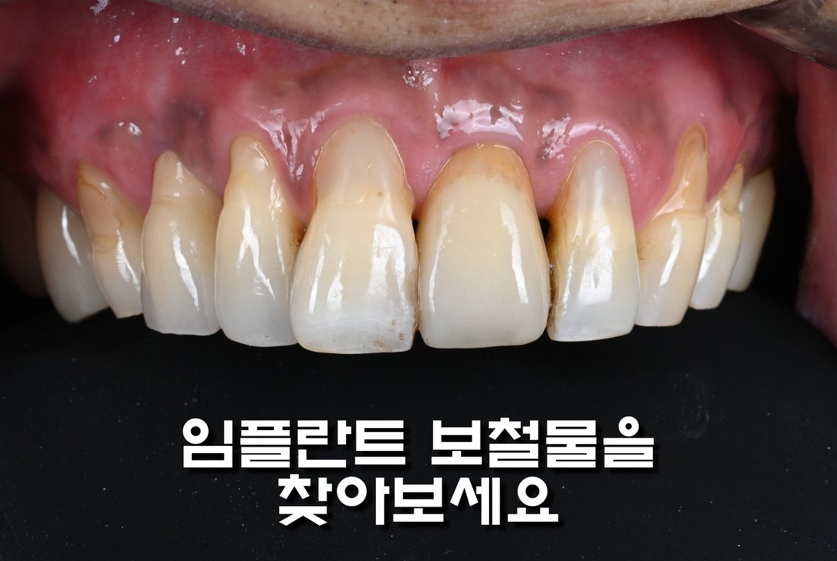 251118 최종보철사진