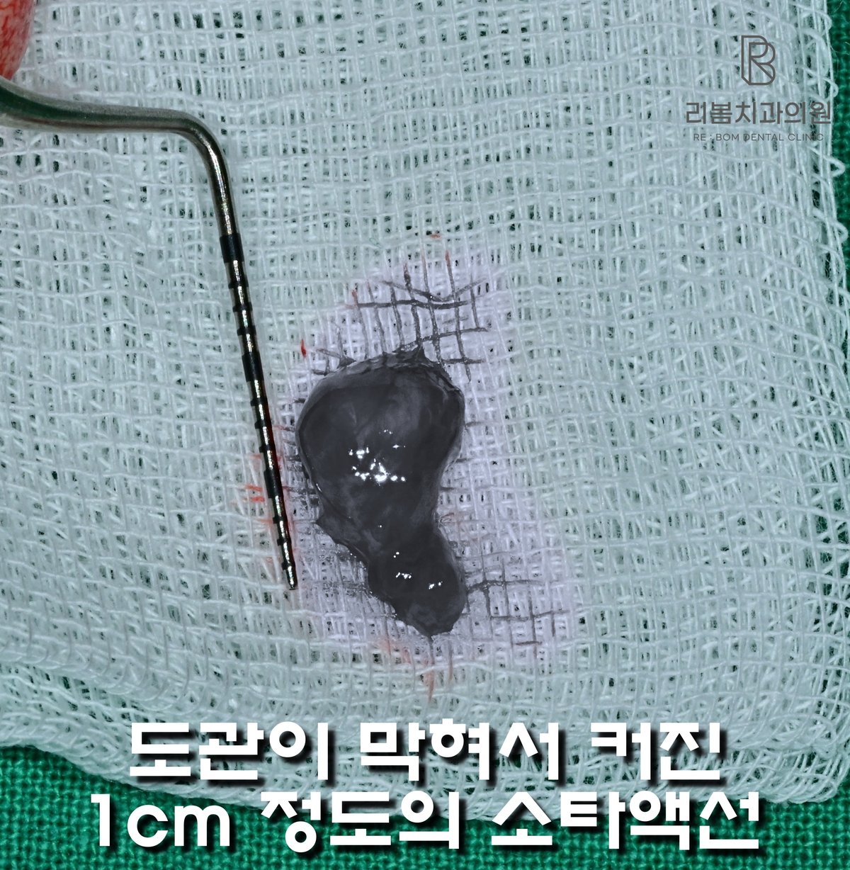 2025.06.27 점액낭종 적출 사진