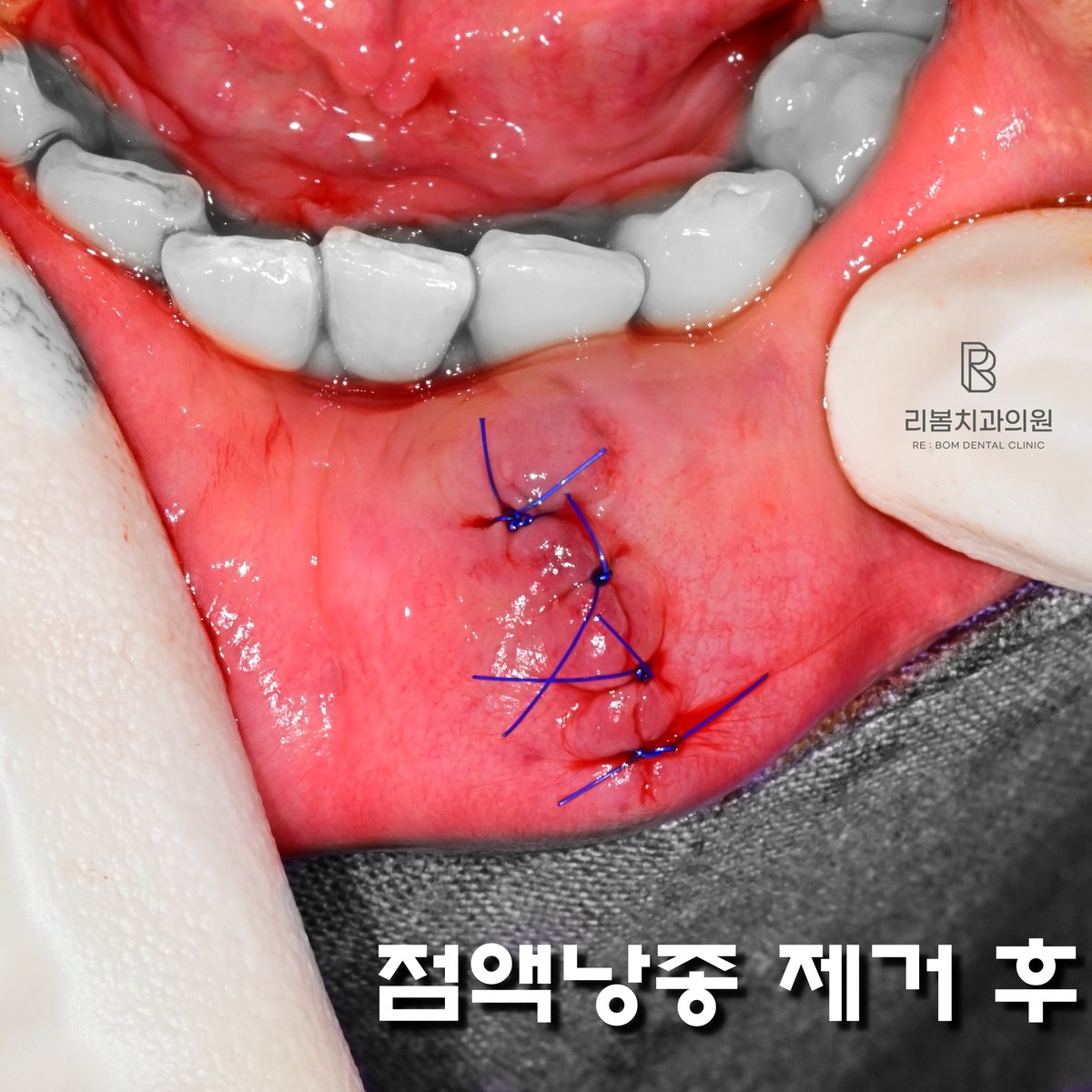 2025.06.27 점액낭종 제거 후 봉합 사진
