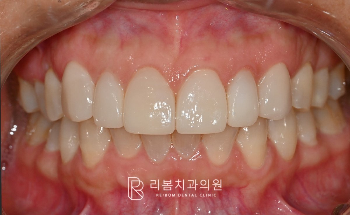 인천 무삭제 라미네이트 세라핏 접착 후