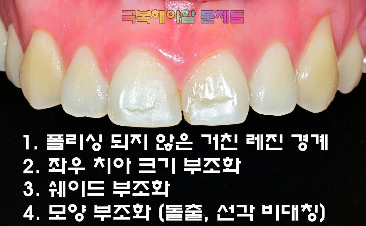 인천 라미네이트 세라핏 진단
