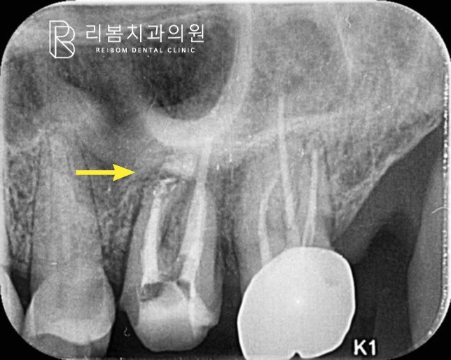수산화 칼슘 첩약한 사진