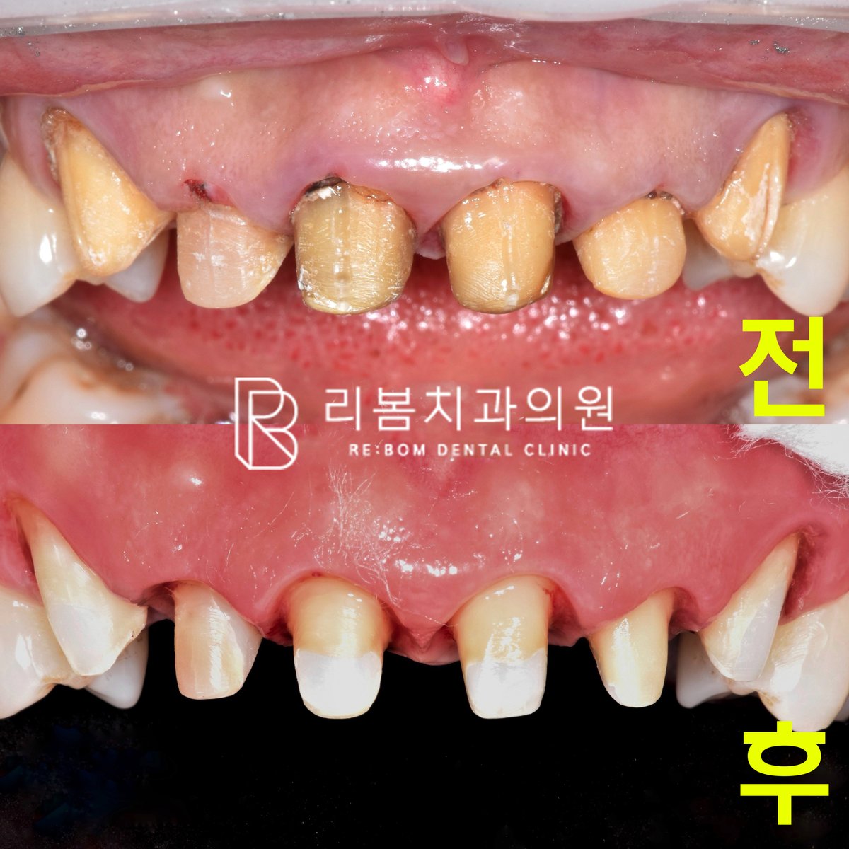 잇몸성형+레진코어+포스트