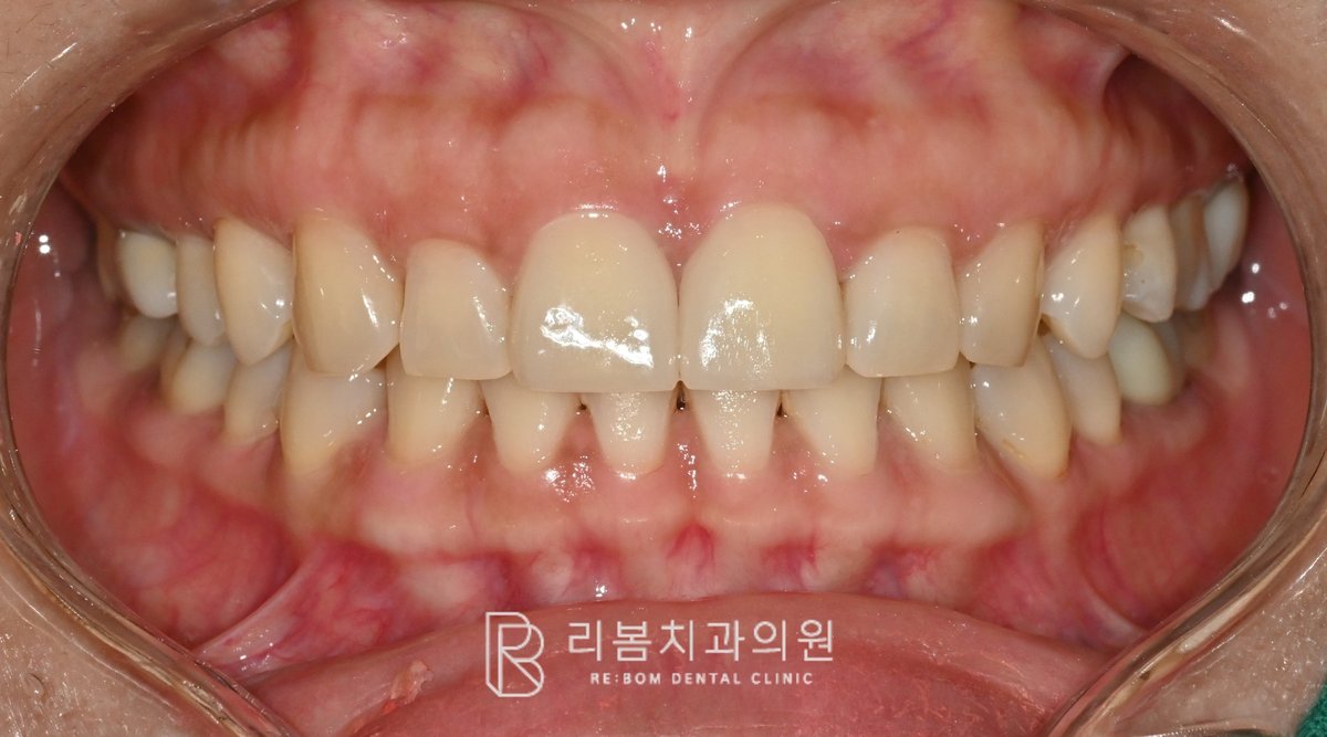 치료 후 사진