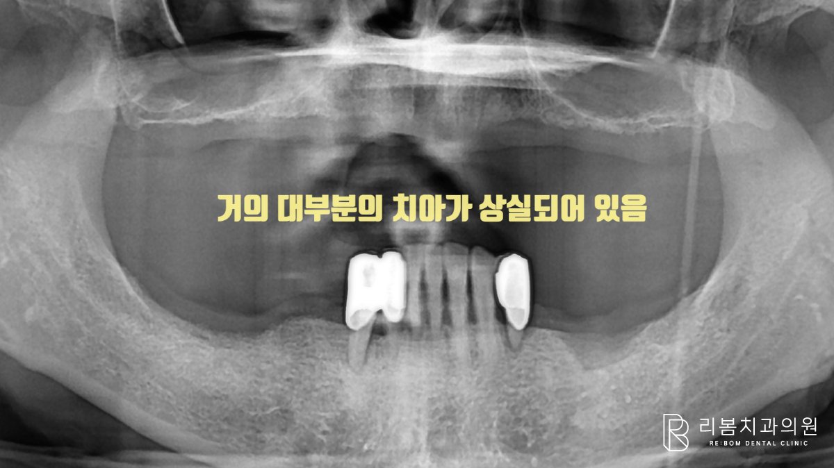 다수의 치아 상실로 인해 치조골이 소실되어 있음