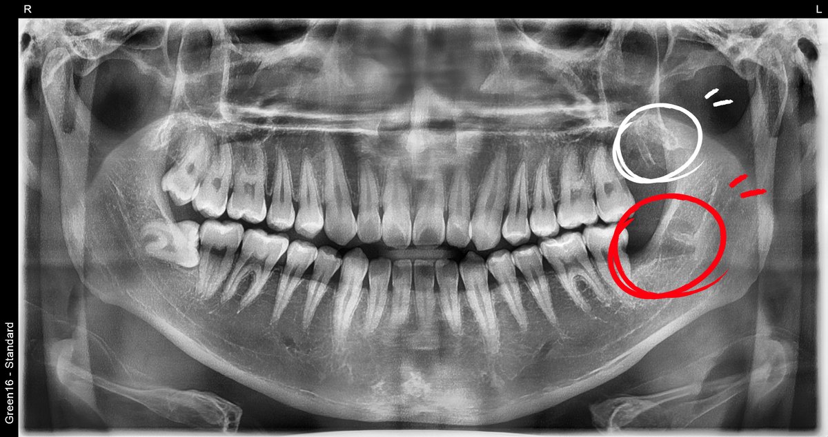 빼고 난 후의 파노라마 x-ray