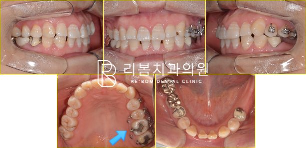 3개월 경과 사진