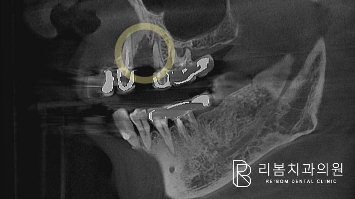 CT에서도 확인할 수 있는 골소실 정도