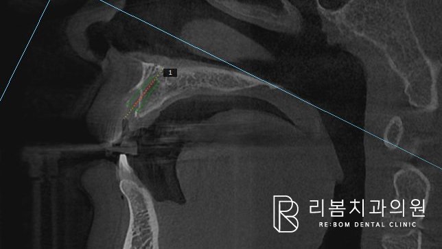 식립 위치를 시뮬레이션 하는 중