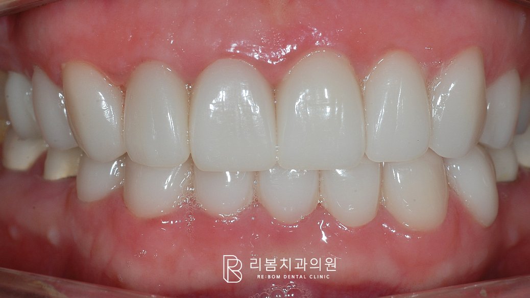 6개 위 앞니를 신경치료 후 올세라믹 보철치료를 완료한 상태