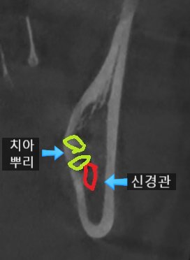 CT를 찍어 미리 신경관의 위치를 확인합니다