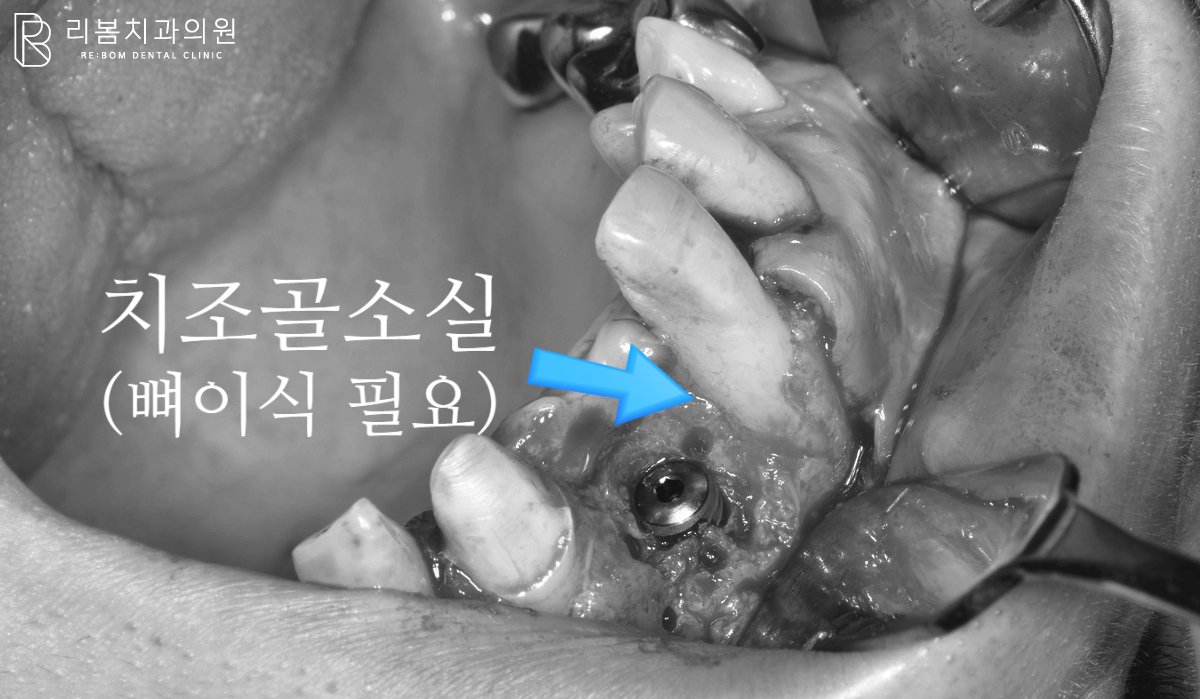 다량의 뼈이식을 성공적으로 끝내야 했습니다.